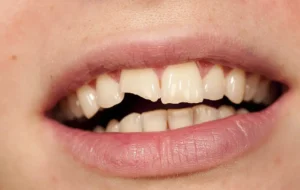 sondrig tand kopiera